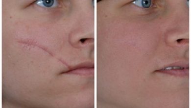 How Can Scar Removal Improve Your Skin