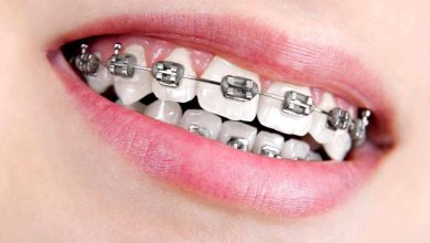 Navigating the Journey to a Perfect Smile with Sea Cliff Braces