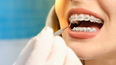 Understanding the Cost of Braces in Elmhurst: What You Need to Know
